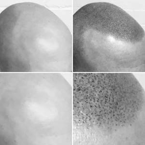 The Look SMP Clinic scalp micropigmentation