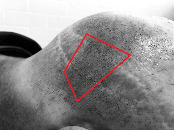 Hair Transplant Scar