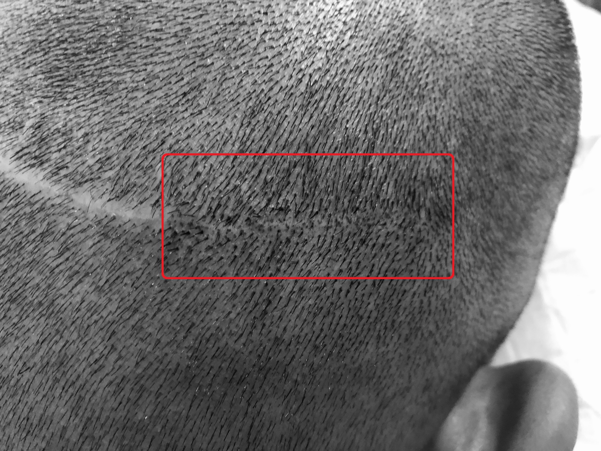 FUT Hair Transplant Scar