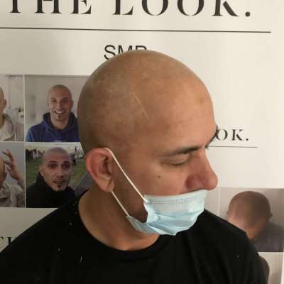 scalp micropigmentation melbourne