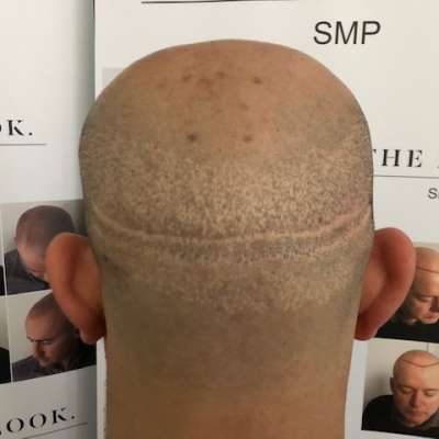 Hair Transplant Scar