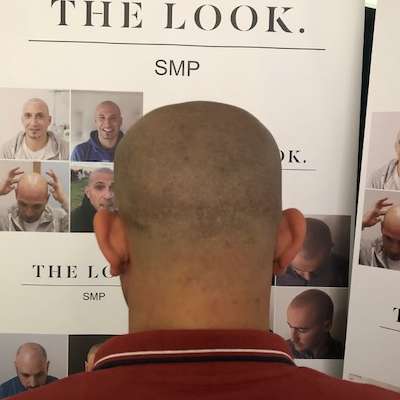Hair Transplant Scar Concealer